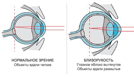 Нормальный глаз схема. Удлиненное глазное яблоко близорукость. Дальнозоркость и близорукость строение глаза. Схема глазного яблока при близорукости. Близорукость строение глаза.